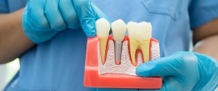 Dental Implants Service