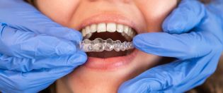 Invisalign Service